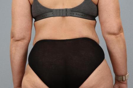 After image 3 Case #128291 - Tummy Tuck 6 months post-op | Salem, OR