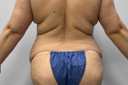 Before image 4 Case #127691 - Mommy Makeover