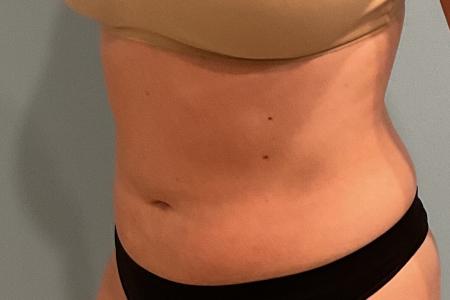 After image 2 Case #127931 - 30 y.o. female w/ Lipo of abs, flanks w/ Renuvion