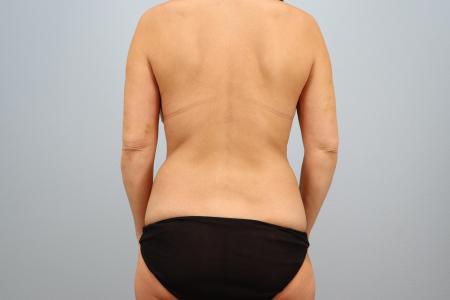 Before image 3 Case #127951 - Mommy Makeover Body Contouring Transformation