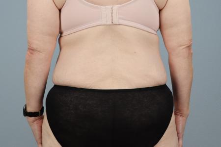 After image 3 Case #127941 - Tummy Tuck Before and After – 60-Year-Old Female