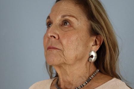 Before image 2 Case #128541 - Facelift and Eyelid Surgery Before and After 