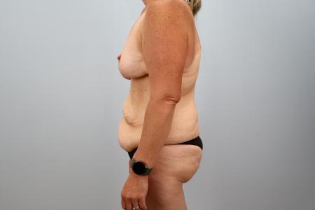 Before image 2 Case #128536 - Mommy Makeover with Breast Implants - 7 Months