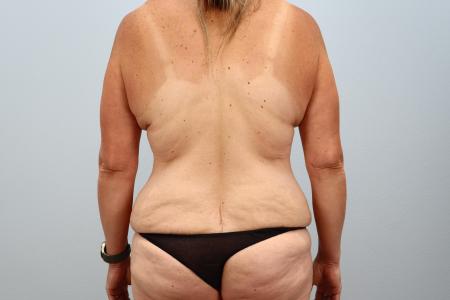 Before image 3 Case #128536 - Mommy Makeover with Breast Implants - 7 Months