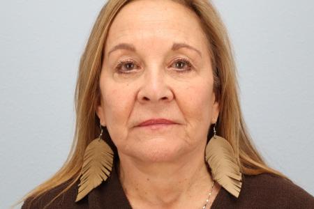 After image 1 Case #128541 - Facelift and Eyelid Surgery Before and After 