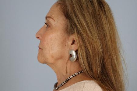 Before image 3 Case #128541 - Facelift and Eyelid Surgery Before and After 