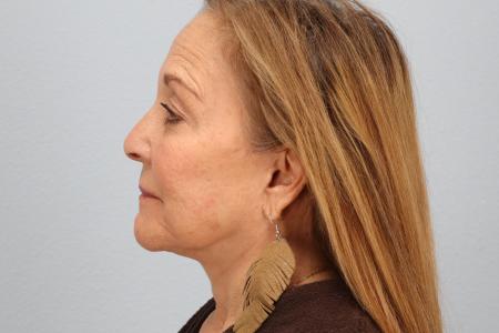 After image 3 Case #128541 - Facelift and Eyelid Surgery Before and After 