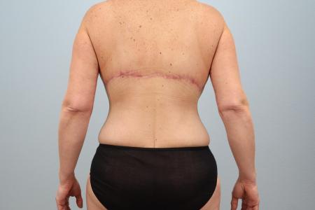 After image 3 Case #128536 - Mommy Makeover with Breast Implants - 7 Months