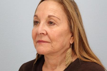 After image 2 Case #128541 - Facelift and Eyelid Surgery Before and After 