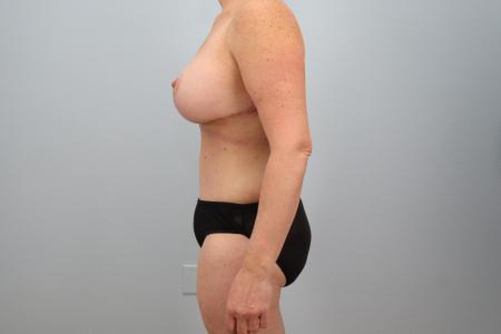 After image 2 Case #128536 - Mommy Makeover with Breast Implants - 7 Months