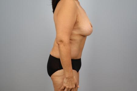 After image 2 Case #128896 - 3 Year Post-Op Mommy Makeover Results | Dr. Neaman