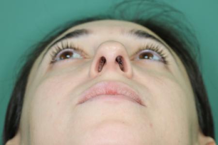 Before image 6 Case #128881 - Primary Rhinoseptoplasty