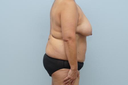 Before image 2 Case #128896 - 3 Year Post-Op Mommy Makeover Results | Dr. Neaman