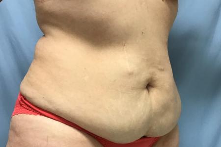 Before image 3 Case #129086 - 50 y.o. female with Tummy Tuck
