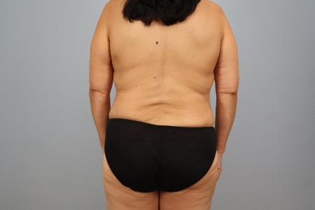 After image 3 Case #128896 - 3 Year Post-Op Mommy Makeover Results | Dr. Neaman