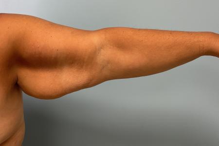 Before image 1 Case #129191 - 58 y.o. female with Brachioplasty and Liposuction