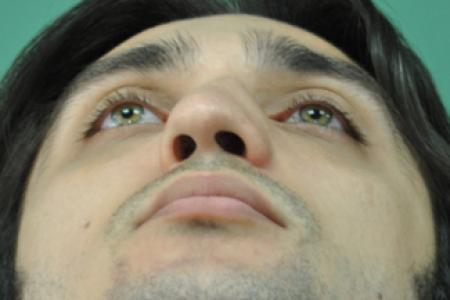 Before image 6 Case #128871 - Primary Septorhinoplasty