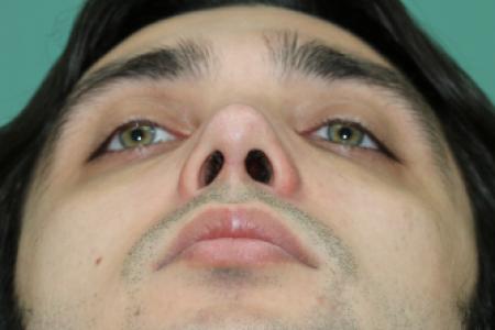 After image 6 Case #128871 - Primary Septorhinoplasty