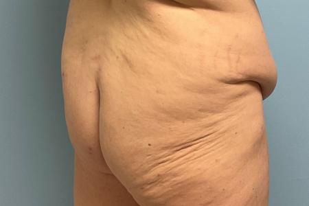 Before image 1 Case #129256 - 38 y.o. with BBL through Fat Transfer