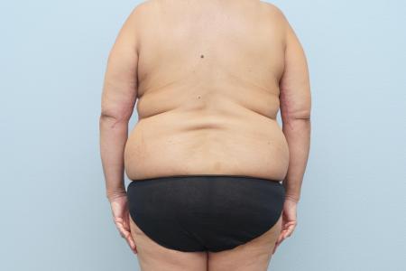 Before image 3 Case #128896 - 3 Year Post-Op Mommy Makeover Results | Dr. Neaman