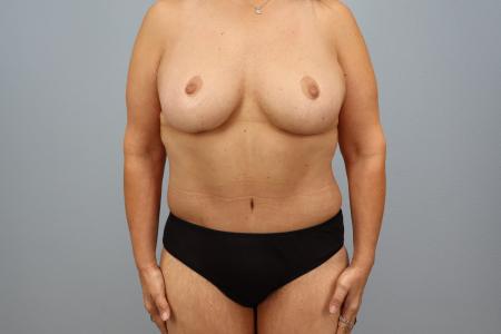After image 1 Case #128896 - 3 Year Post-Op Mommy Makeover Results | Dr. Neaman