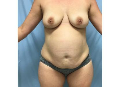 Before image 1 Case #129106 - 39 y.o. female w/ Tummy Tuck, Lipo & Fat Transfer