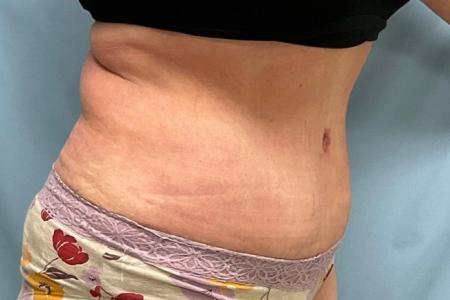 After image 3 Case #129086 - 50 y.o. female with Tummy Tuck