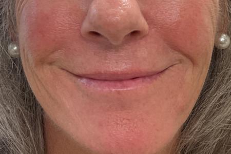 Before image 1 Case #129941 - 62 y.o. female with Lip Filler
