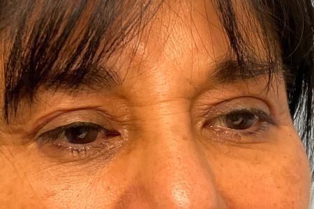 After image 1 Case #129536 - 58 y.o. female w/ Upper Blepharoplasty