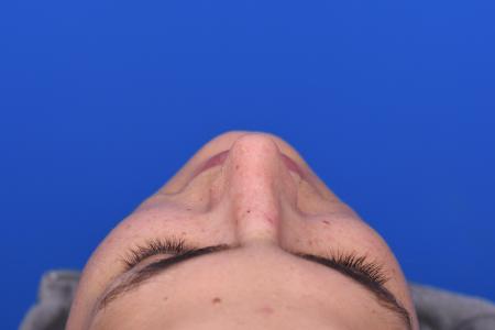After image 6 Case #129951 - RHINOPLASTY