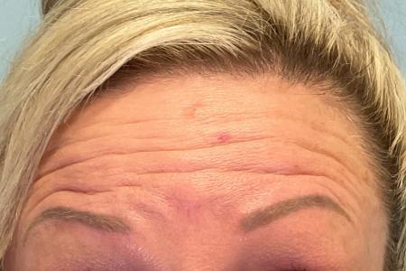 Before image 1 Case #129631 - 46 y.o. female with Botox