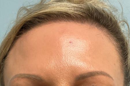 After image 2 Case #129631 - 46 y.o. female with Botox