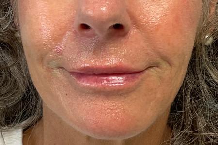 After image 1 Case #129941 - 62 y.o. female with Lip Filler