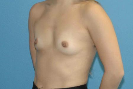 Before image 2 Case #130166 - Primary Breast Augmentation