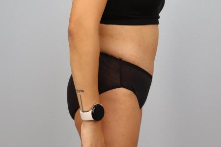 After image 2 Case #130171 - Skin Removal Surgery: Tummy Tuck with Lipo 360