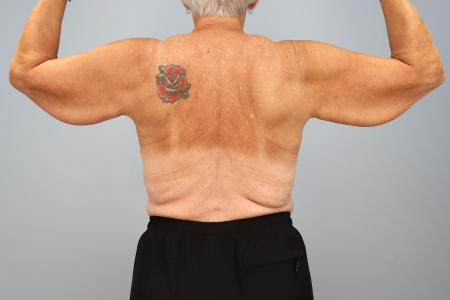 Before image 2 Case #130191 - Arm Lift (Brachioplasty) – 6 Month Results