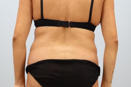 Before image 3 Case #130171 - Skin Removal Surgery: Tummy Tuck with Lipo 360