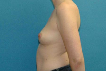 Before image 3 Case #130286 - Breast Augmentation
