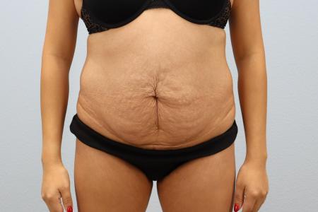 Before image 1 Case #130171 - Skin Removal Surgery: Tummy Tuck with Lipo 360