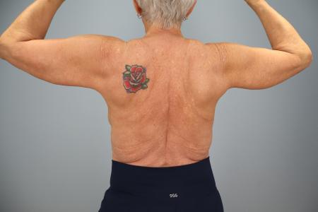 After image 2 Case #130191 - Arm Lift (Brachioplasty) – 6 Month Results