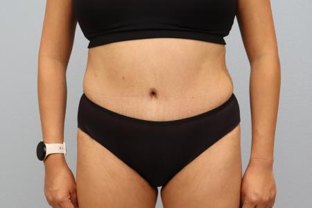 After image 1 Case #130171 - Skin Removal Surgery: Tummy Tuck with Lipo 360