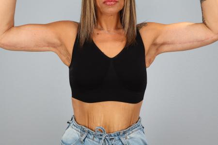 After image 1 Case #130531 - Arm Lift After Weightloss