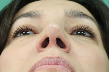 After image 6 Case #130881 - Conventional Septorhinoplasty