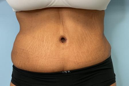 After image 1 Case #131026 - 54 y.o. female with Tummy Tuck & Lipo of Flanks