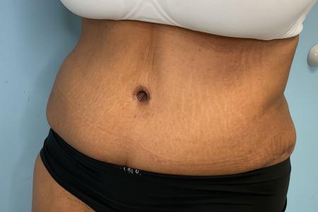 After image 2 Case #131026 - 54 y.o. female with Tummy Tuck & Lipo of Flanks