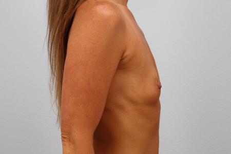 Before image 3 Case #130711 - 48 year old female Breast Augmentation Results