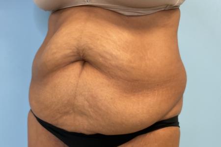Before image 2 Case #131026 - 54 y.o. female with Tummy Tuck & Lipo of Flanks