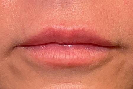 After image 1 Case #132466 - 46 y.o. female with Lip Filler