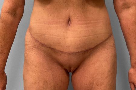 After image 1 Case #132781 - Tummy Tuck