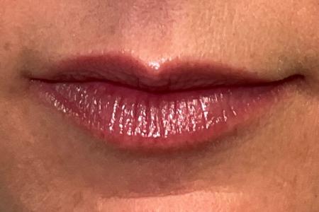 After image 1 Case #132306 - 49 y.o. female with Botox (Lip Flip)